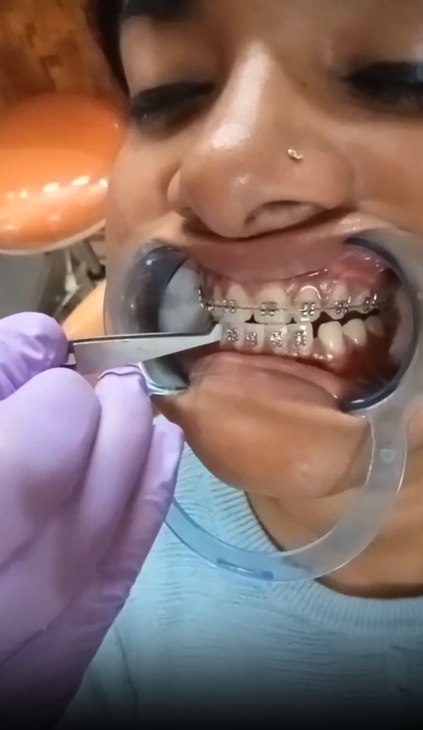 Braces Treatment Video