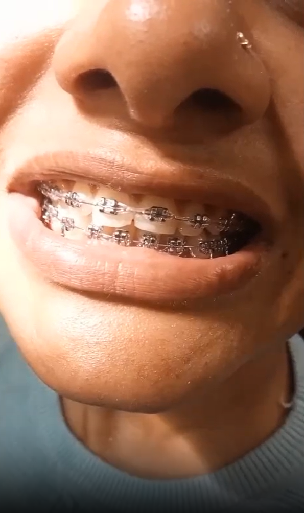 Braces Treatment Video