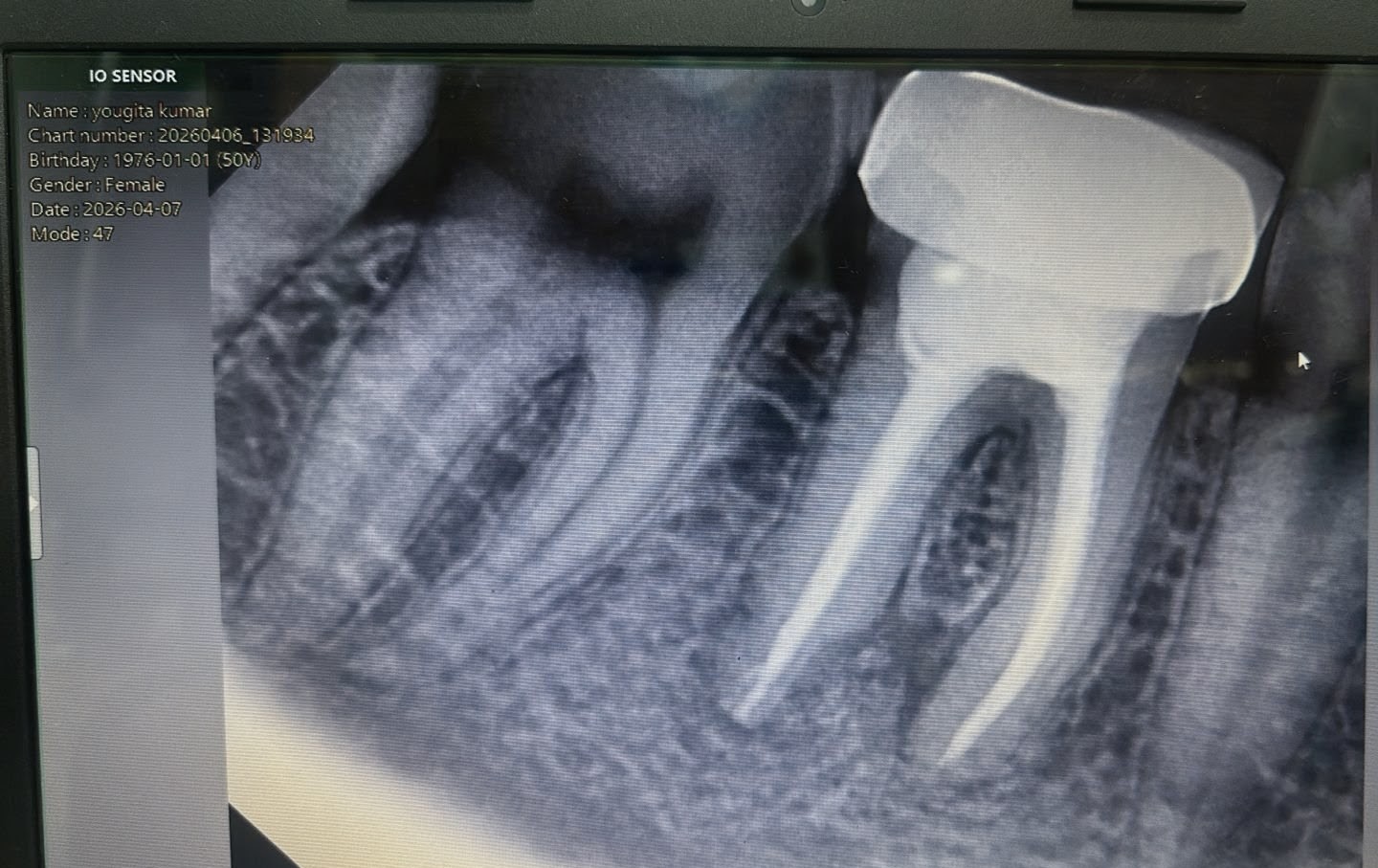 Painless Root Canal