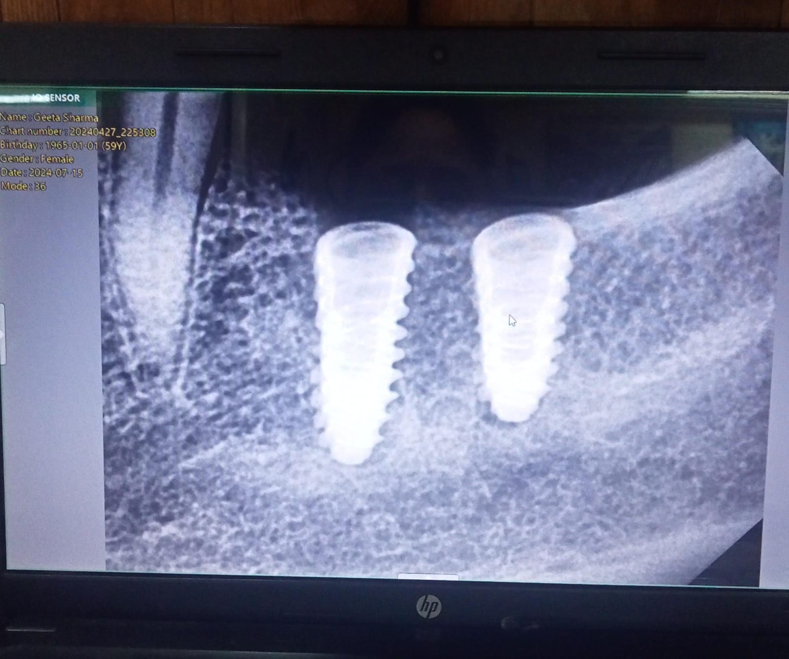 Full Mouth Implant