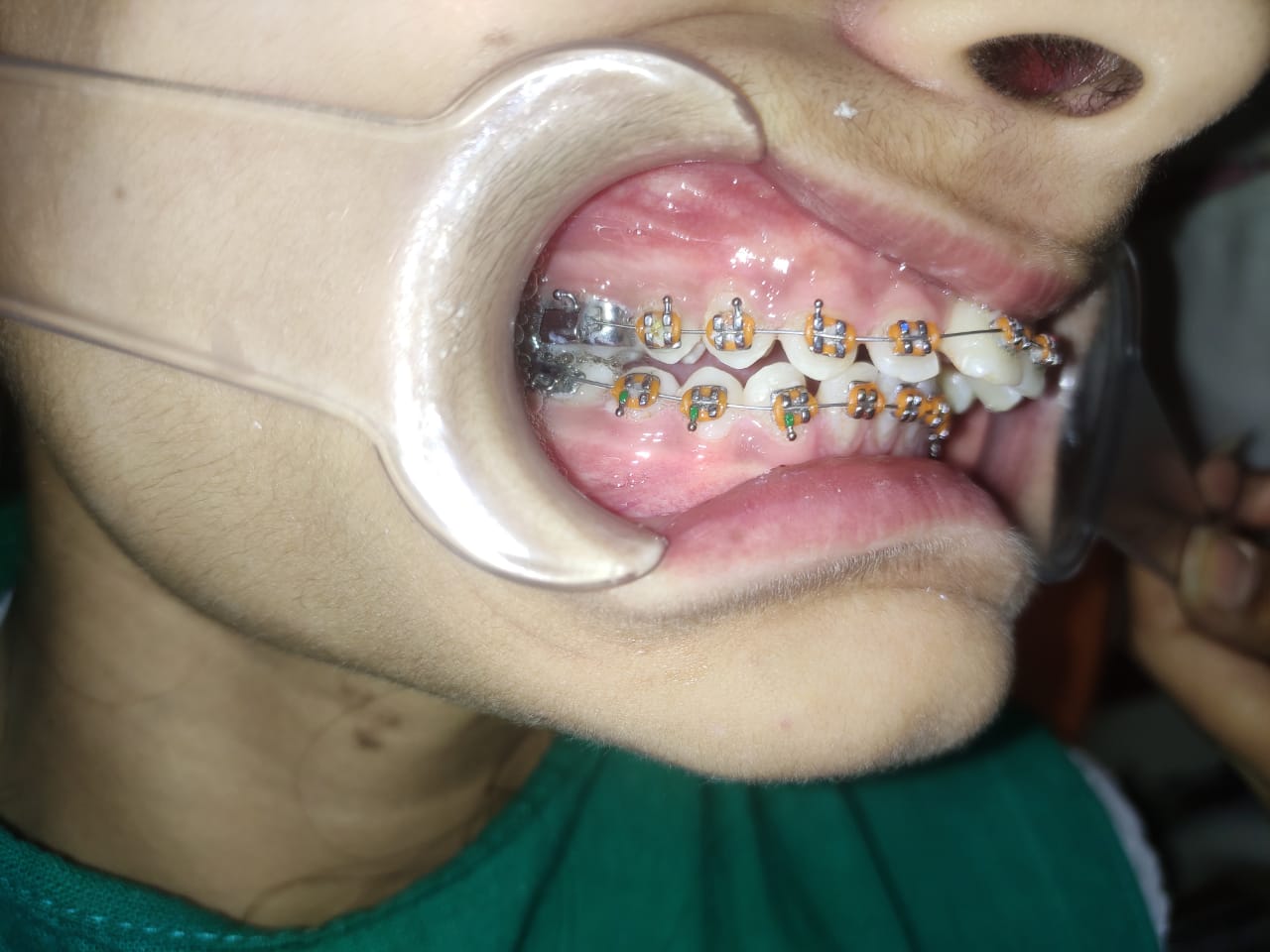 Smile Correction Case