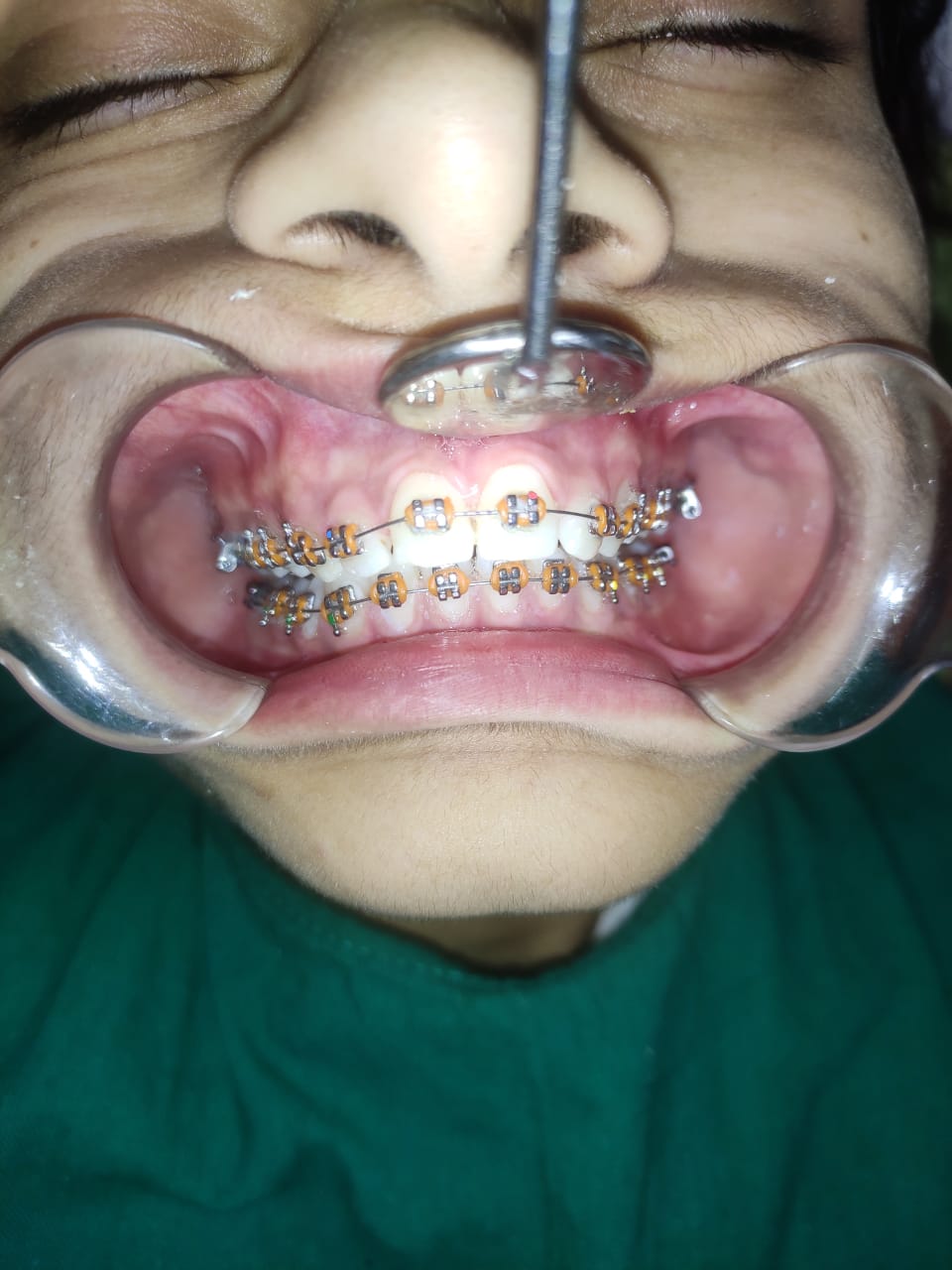 Smile Correction Case