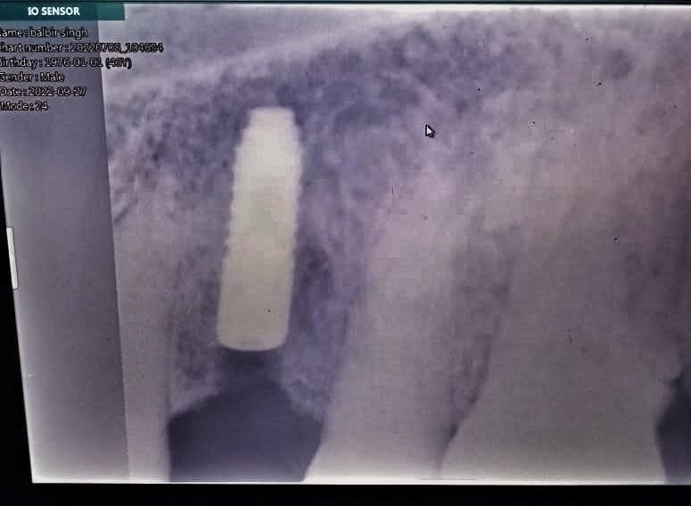 Full Mouth Implant