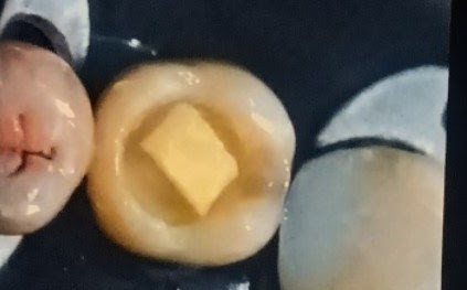 Endodontic Treatment Case