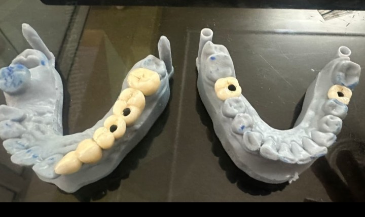 Natural Looking Crowns