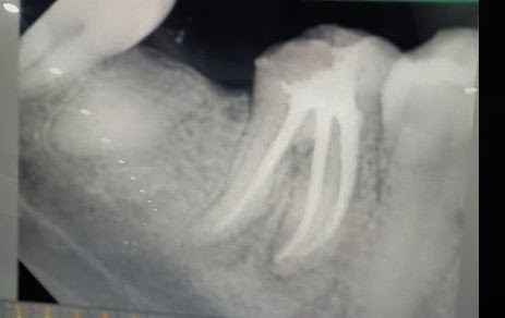 root canal treatment